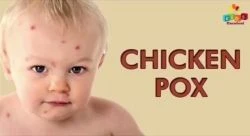 What about chicken pox? Contagious virus or something else?