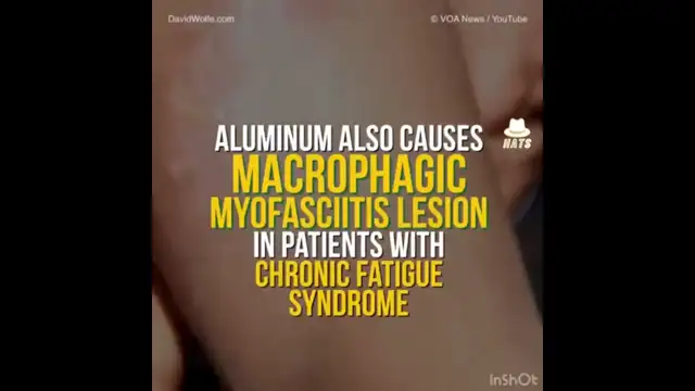 This is where the aluminum in vaccines goes into your body after vaccinations.