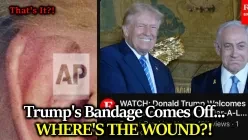 BIG REVEAL: Trump's Bandage Comes Off Showing... Minor Discoloration?  Can The Gaslighting Stop Now?
